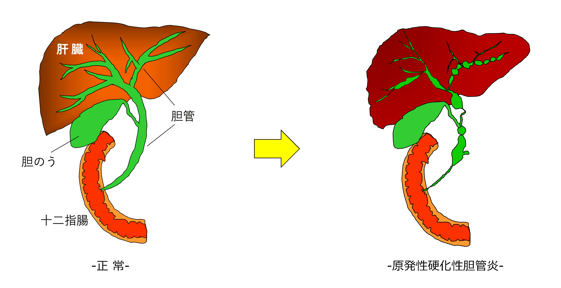原発性胆汁性肝硬変と原発性硬化性胆管炎の症状