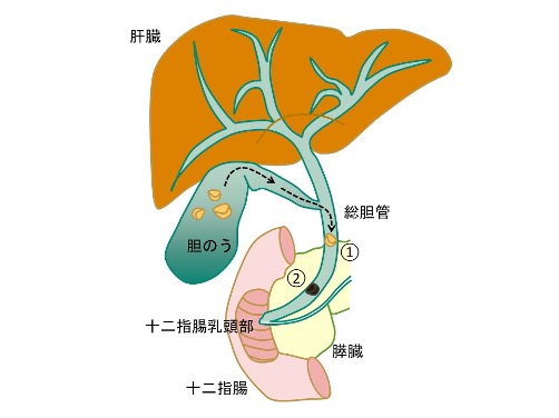 胆管ステントはいつ除去すべきですか?