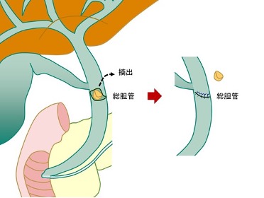 ステージ0の肺がんの治療